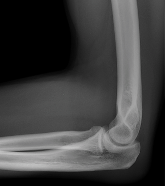 Use transitions often and fluidly, the way you use your elbows. (X-ray of the elbow courtesy of Wikimedia Commons, public domain.)